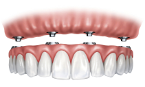 Dentier stabilisé sur implants