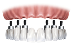 implant-plusieurs-dents
