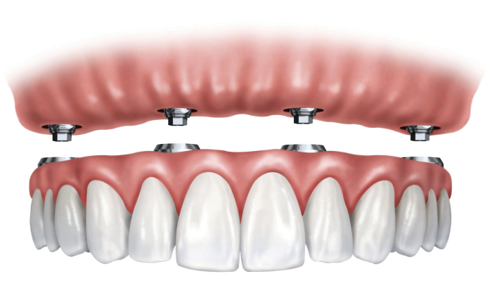 Modèle de Dent D'implant Dentaire, Modèle de Dents Dentaires, Modèle de  Dents Standard Modèle Dentaire Pédagogique à Dents Inférieures Amovibles et